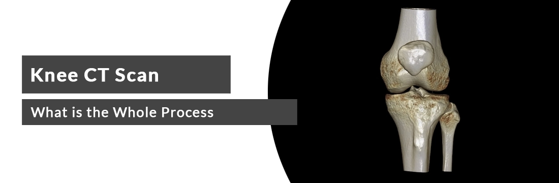 Knee CT Scan: What is the Whole Process